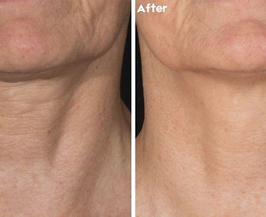 Before and After Potenza RF Microneedling.jpg