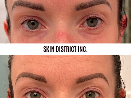 before and after photos after novaderm resurfacing laser treatment