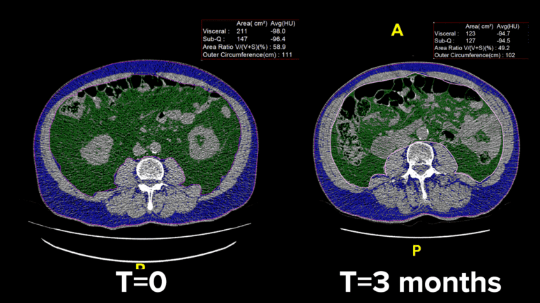 do glp 1 reduce visceral fat The Insulin Paradox: How GLP-1 Drugs Reduce Belly Fat and Heart Risk | VAT  Trap