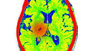 How AFib can present as a heart attack or stroke