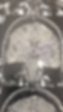 Tumor cerebral - Meningioma