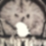 Macroadenoma Hipofisário - Tumor cerebral Tumor benigno que nunca mal
