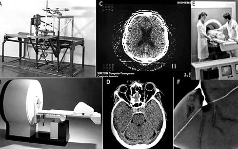História da invenção e desenvolvimento da Tomografia Computadorizada na Inglaterra em 1971