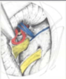 Nevralgia do trigêmeo - Descompressão neurovascular cura . Dr. Eric Grossi Neurocirurgião BH