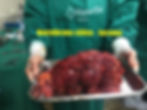 Neurofibromatose tipo 1 raríssima tr