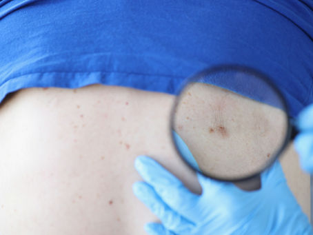 What St. Louis Patients Should Know About Squamous Cell Carcinoma Scars
