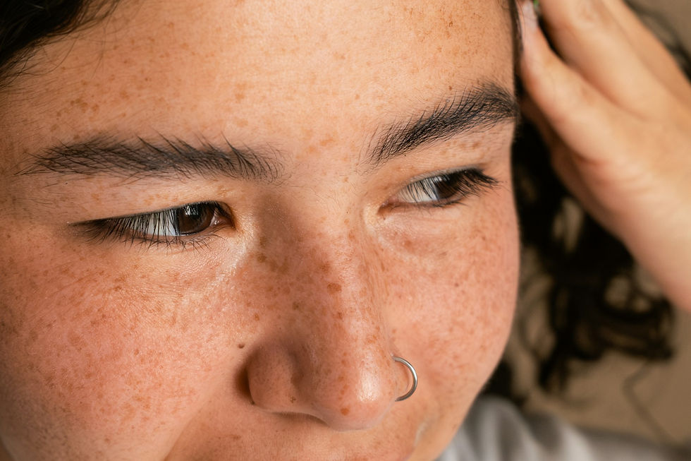 a woman with melasma