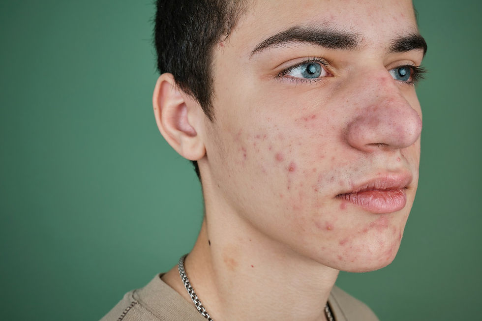 acne