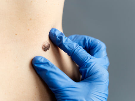 mole removal