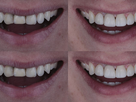 Facetas e Lentes de Contato em Resina Composta - A especialidade do Dr. Henrique Tabuse