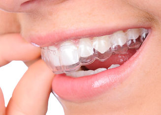 invisalign-faqs.jpg