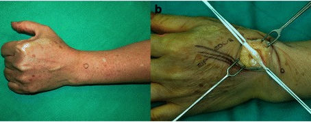 探討長伸肌腱自發性破裂:八例無明顯誘因