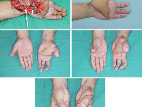 對掌肌腱轉移術為提供可預測的對掌三指捏合以重建近端拇指缺陷