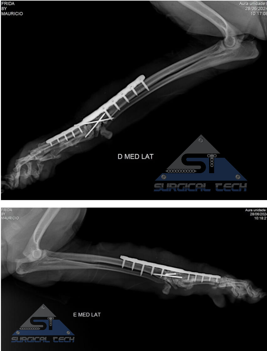 Miniatura: Placa Híbrida Titânio 1.5/2.0 ST