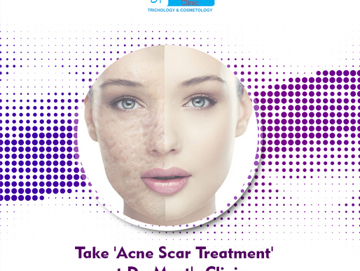 Get Rid of Acne Scars Before This Wedding Season
