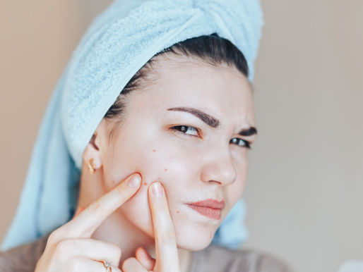 Acne Scars Treatment in Indore at Dr. Meet's Clinic