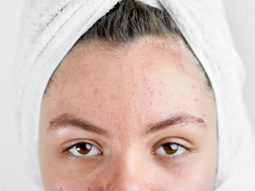 A Sure-Shot 'Acne Scar Treatment at Dr. Meet's Clinic