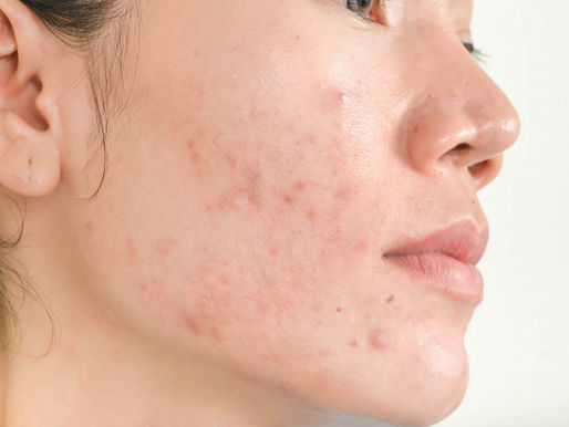 The Do's And The Dont's Of Acne