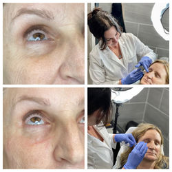 DERMAL FILLER