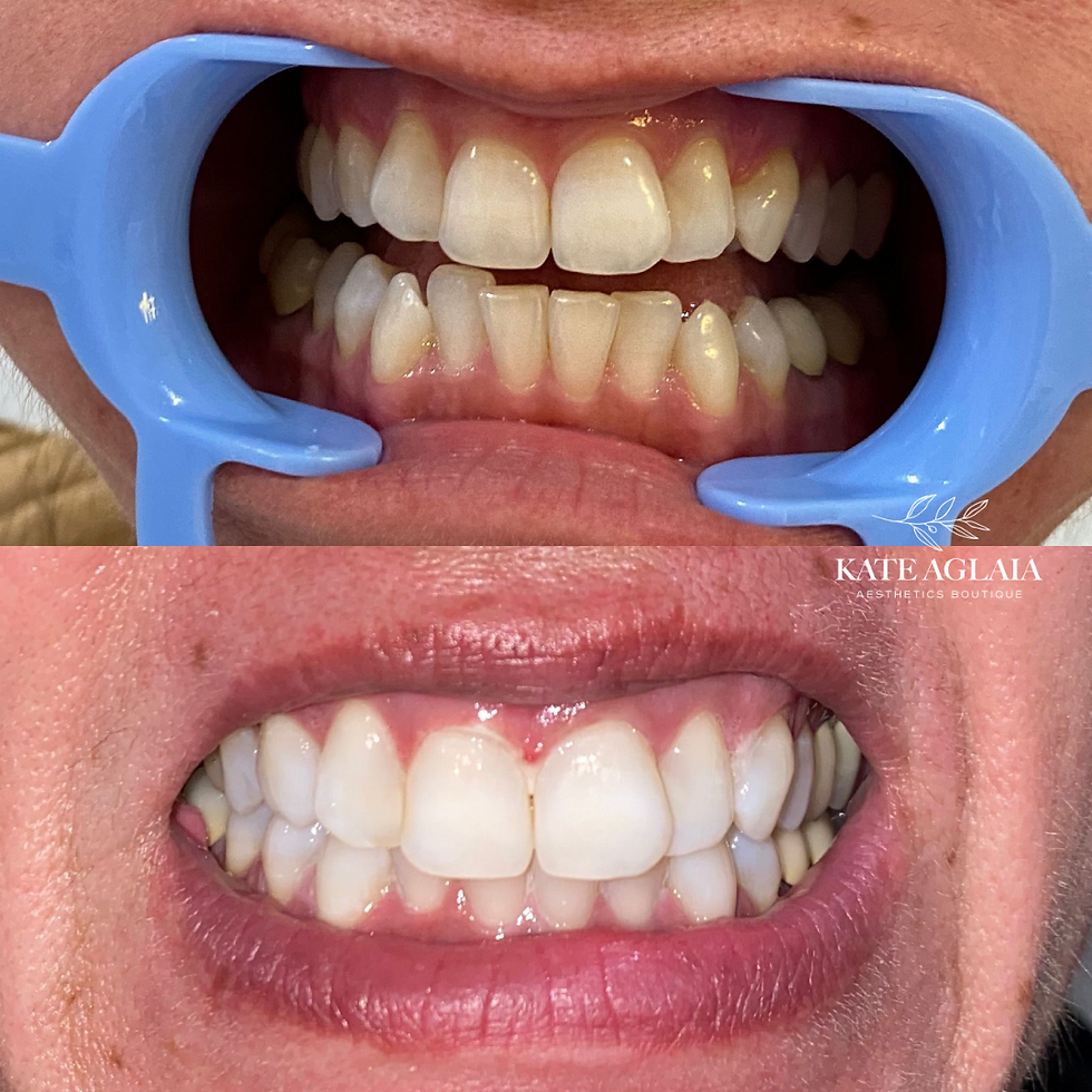 Teeth Whitening Before After