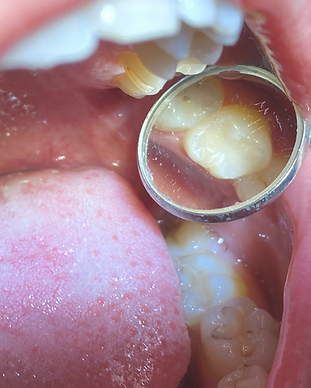 FILLING%2520DENTAL%2520ON%2520ERRARD_edi