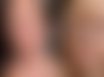 Mulher com doença rara já fez mais de 300 cirurgias e gasta um frasco de protetor solar por dia: 'Cada pintinha virava tumor'