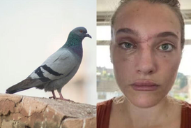 Modelo sofre acidente com um pombo e fica com sequela grave no cérebro