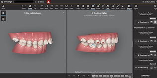 Invisalign ClinCheck