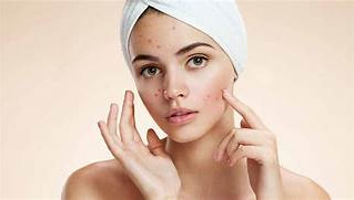 My Acne Journey with Allie: A Real Life Review From my Client Kari