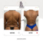 360 Liposuction @ SNU