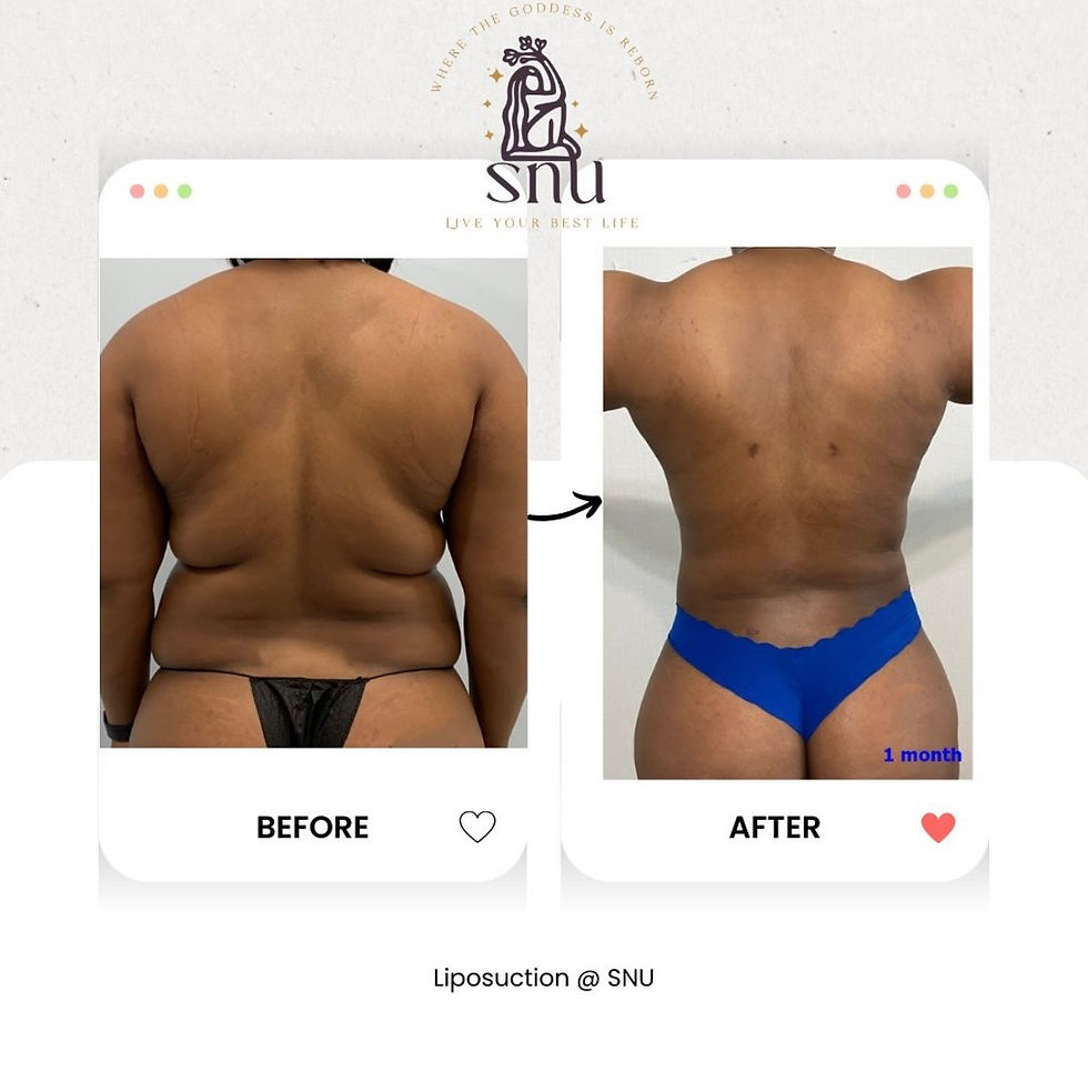 360 Liposuction @ SNU