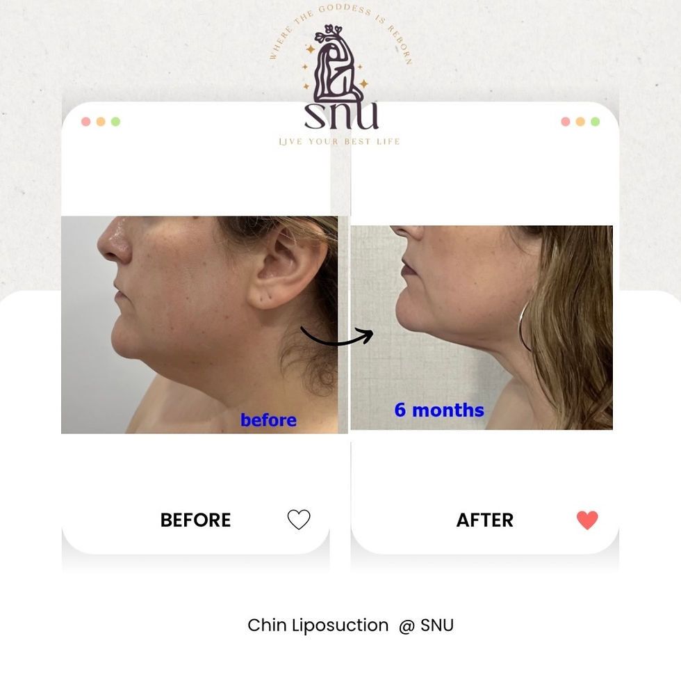 Chin Liposuction @ SNU