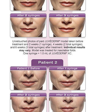 Relleno Juvederm
