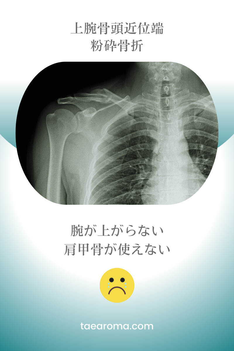 上腕骨頭近位端の粉砕骨折