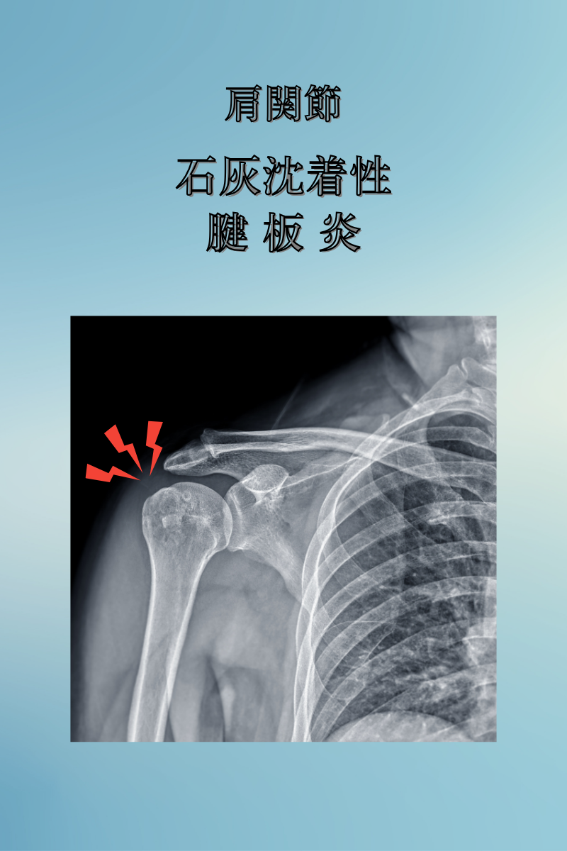 肩に激痛…「石灰沈着性腱板炎」って?