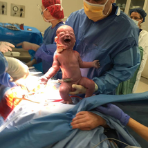 baby born via caesarean section