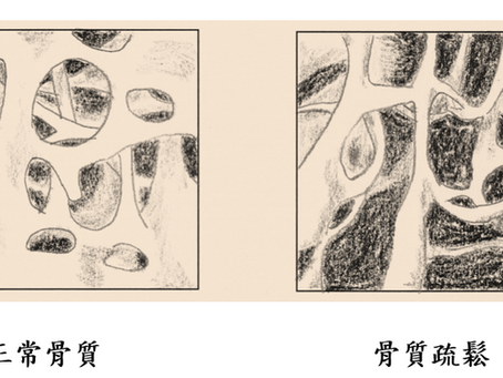 骨質疏鬆最怕跌倒 保密防跌人人有擇