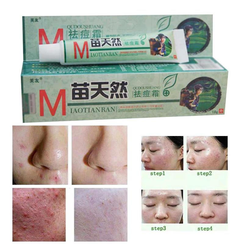 Thumbnail: 1 Pc Natural Germicidal Removel Skin Cream Original Remove Acne Cream 