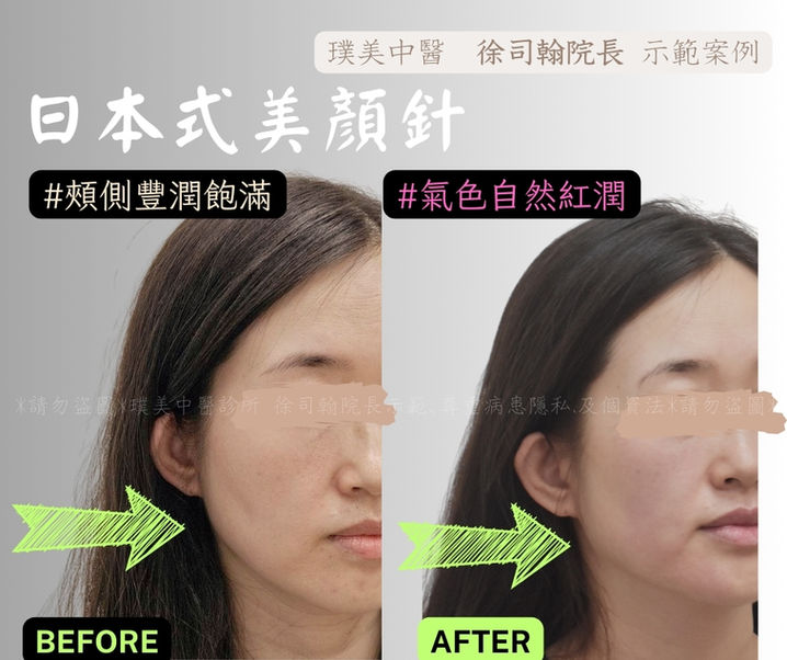 璞美中醫美顏針-全臉治療前後對比圖