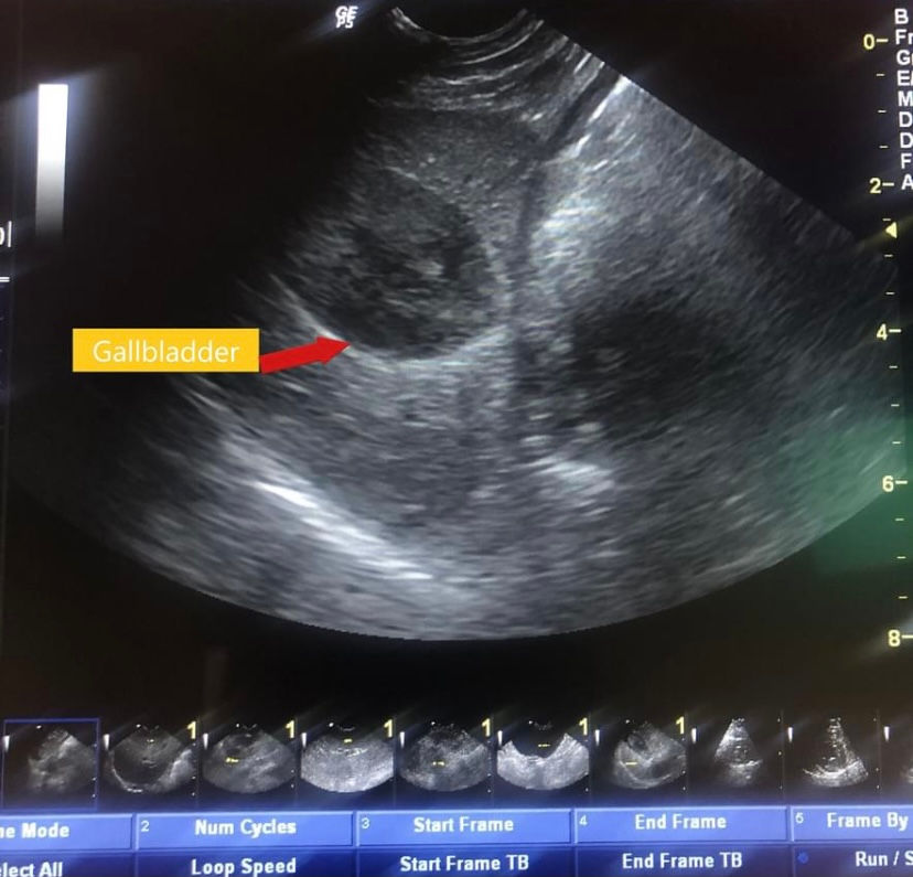Gallbladder US.jpeg