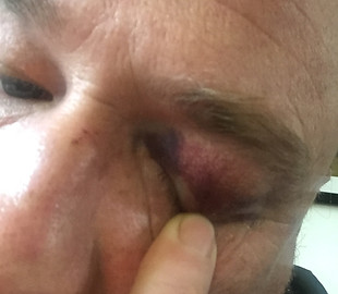 black eye.jpeg