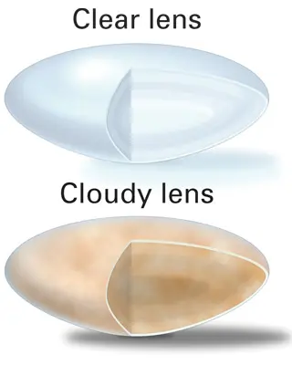 Cataract---Clear-and-Cloudy-Lenses.webp