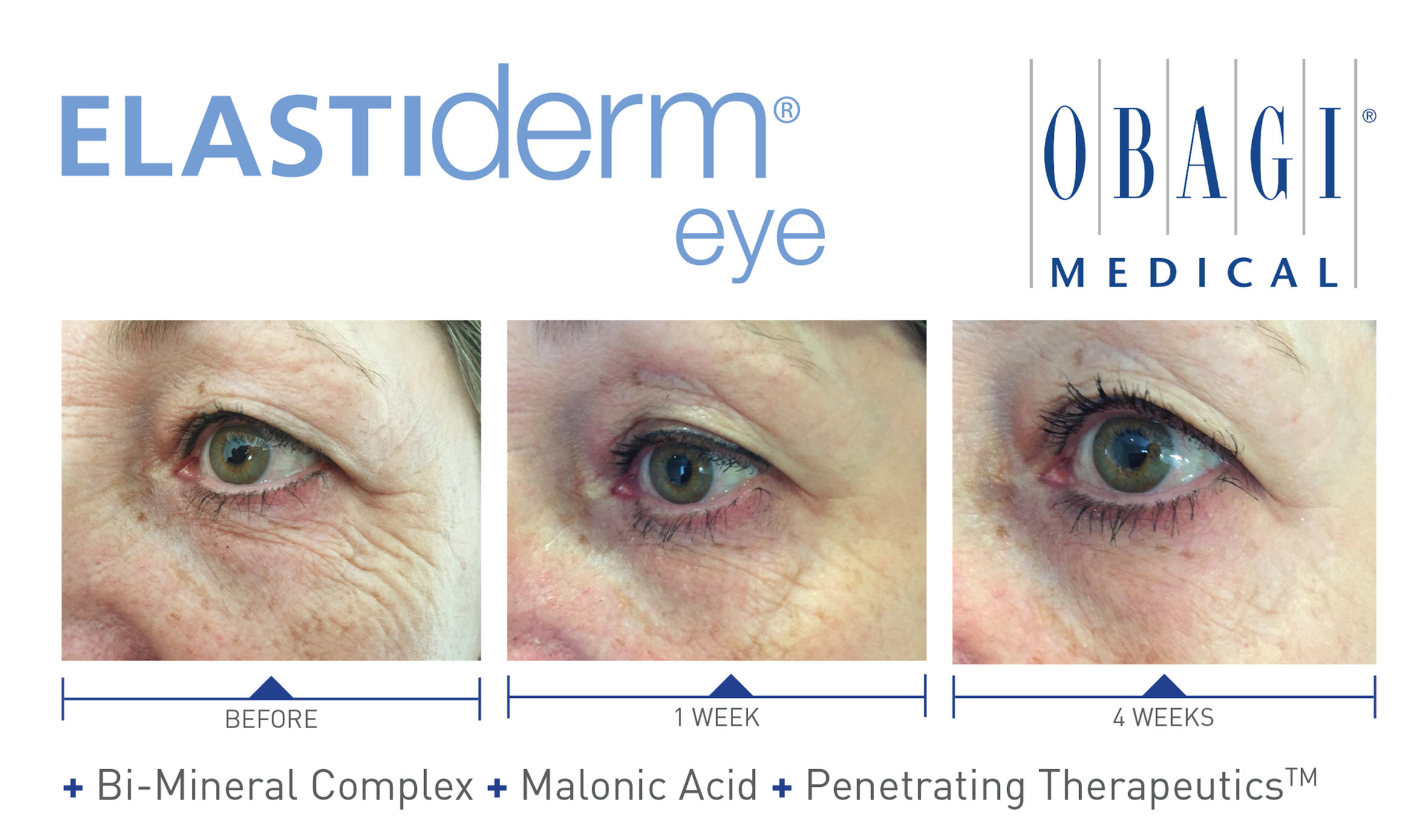 obagi elastiderm eye cream before and after