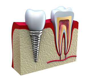 dental-implant.jpg