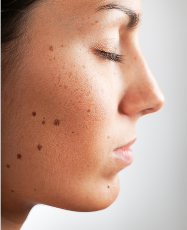 woman with face moles