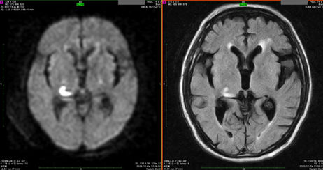 脳梗塞による視野障害