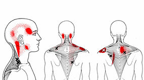 miyofasial ağrı sendromu.jpg