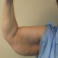 brachioplasty 1 pre.jpeg