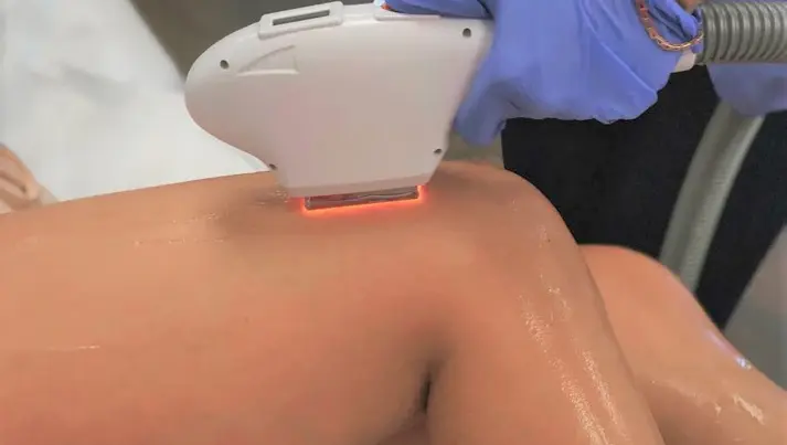 hair removal