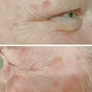 crows feet, neurotoxin injections, botox, daxxify, jeuveau, xeomin